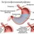 Гастрит, ГЭРБ, эзофагит, срк, панкреатит